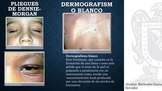 Alumno: Bermudez Garcia
Salvador
PLIEGUES
DE DENNIE-
MORGAN
DERMOGRAFISM
O BLANCO
Dermografismo blanco
Este fenómeno, que consiste en la
formación de una línea o zona más
pálida que el resto de la piel al
golpearla o presionarla con un
instrumento romo, revela una
vasoconstricción local producida
por una elevación de los niveles de
histamina
 