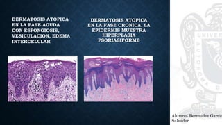 Alumno: Bermudez Garcia
Salvador
DERMATOSIS ATOPICA
EN LA FASE CRONICA. LA
EPIDERMIS MUESTRA
HIPERPLASIA
PSORIASIFORME
 