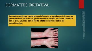 DERMATITIS IRRITATIVA
Es un dermatitis por contacto tipo inflamatoria, aguda o crónica que se
presenta como respuesta a gentes externos cuando entran en contacto
con la piel. Causada por el efecto citotóxico directo sobre los
queratinocitos.
 