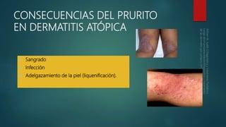 CONSECUENCIAS DEL PRURITO
EN DERMATITIS ATÓPICA
 Sangrado
 Infección
 Adelgazamiento de la piel (liquenificación).
 