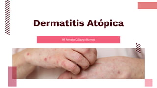 Dermatitis Atópica
IM Renato Calizaya Ramos
 