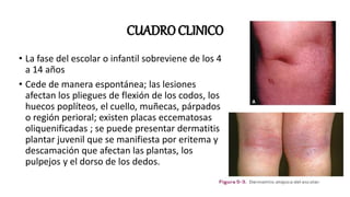 DERMATITIS ATOPICA.pptxDFGHJKLXCVBNM,FGHJKLFGHJKL | PPTX