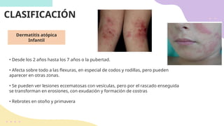 DERMATITIS ATOPICA EN PEDIATRIA, BASES INMUNOLOGICAS | PPTX
