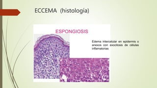 ECCEMA (histología)
Edema intercelular en epidermis o
anexos con exocitosis de células
inflamatorias
 