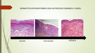 DERMATITIS ESPONGIFORMES SON UN PROCESO DINÁMICO ( FASES)
AGUDA SUB AGUDA CRÓNICA
 