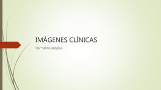IMÁGENES CLÍNICAS
Dermatitis atópica
 