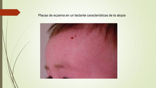 Placas de eczema en un lactante características de la atopia
 