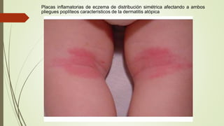 Placas inflamatorias de eczema de distribución simétrica afectando a ambos
pliegues poplíteos característicos de la dermatitis atópica
 