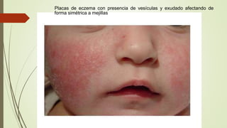 Placas de eczema con presencia de vesículas y exudado afectando de
forma simétrica a mejillas
 
