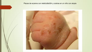 Placas de eczema con vesiculación y costras en un niño con atopia
 