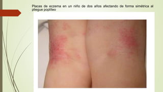 Placas de eczema en un niño de dos años afectando de forma simétrica al
pliegue poplíteo
 