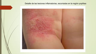 Detalle de las lesiones inflamatorias, escoriadas en la región poplítea
 