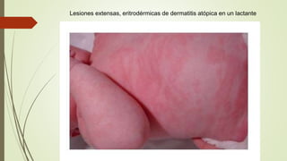 Lesiones extensas, eritrodérmicas de dermatitis atópica en un lactante
 