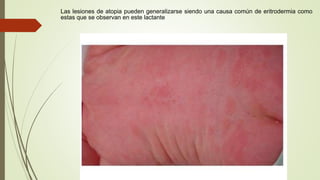 Las lesiones de atopia pueden generalizarse siendo una causa común de eritrodermia como
estas que se observan en este lactante
 