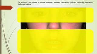 Paciente atópico que en el que se observan lesiones de queilitis, palidez perioral y dermatitis
de los parpados
 