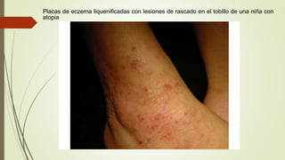Placas de eczema liquenificadas con lesiones de rascado en el tobillo de una niña con
atopia
 