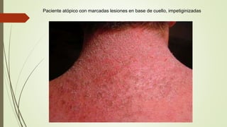 Paciente atópico con marcadas lesiones en base de cuello, impetiginizadas
 