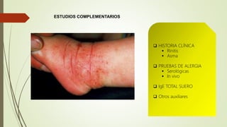 ESTUDIOS COMPLEMENTARIOS
 HISTORIA CLÍNICA
 Rinitis
 Asma
 PRUEBAS DE ALERGIA
 Serológicas
 In vivo
 IgE TOTAL SUERO
 Otros auxiliares
 