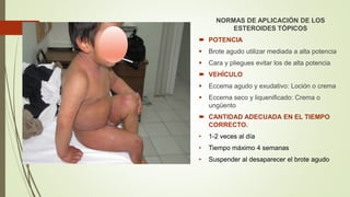 NORMAS DE APLICACIÓN DE LOS
ESTEROIDES TÓPICOS
 POTENCIA
 Brote agudo utilizar mediada a alta potencia
 Cara y pliegues evitar los de alta potencia
 VEHÍCULO
 Eccema agudo y exudativo: Loción o crema
 Eccema seco y liquenificado: Crema o
ungüento
 CANTIDAD ADECUADA EN EL TIEMPO
CORRECTO.
• 1-2 veces al día
• Tiempo máximo 4 semanas
• Suspender al desaparecer el brote agudo
 