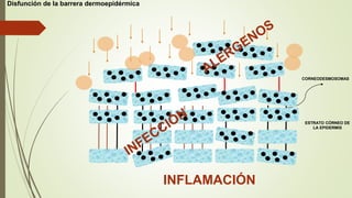 Disfunción de la barrera dermoepidérmica
ESTRATO CÓRNEO DE
LA EPIDERMIS
CORNEODESMOSOMAS
INFLAMACIÓN
 