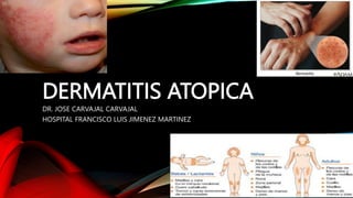 DERMATITIS ATOPICA
DR. JOSE CARVAJAL CARVAJAL
HOSPITAL FRANCISCO LUIS JIMENEZ MARTINEZ
 