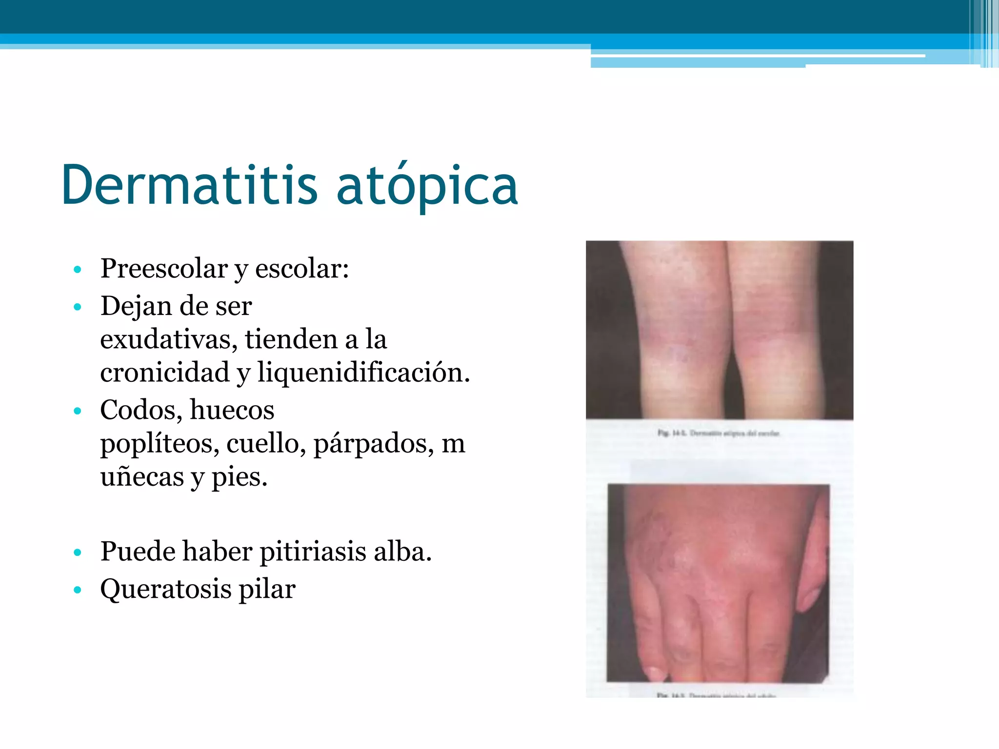 Dermatitis atopica curso enarm cmn siglo xxi | PPTX