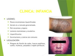 CLINICA: INFANCIA
 LESIONES:
 Placas eccematosas liquenificadas
 Xerosis es a menudo generalizada.
 Piel escamosa y áspera
 Lesiones exematosas y exudativa.
 Liquenificacion
 Excoriaciones y costras son comunes
 LOCALIZACIÓN:
 Pliegues de flexión de codos, huecos poplíteos,
cuello, muñecas, parpados o región peribucal;
 