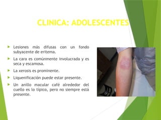 CLINICA: ADOLESCENTES
 Lesiones más difusas con un fondo
subyacente de eritema.
 La cara es comúnmente involucrada y es
seca y escamosa.
 La xerosis es prominente.
 Liquenificación puede estar presente.
 Un anillo macular café alrededor del
cuello es lo típico, pero no siempre está
presente.
 