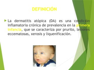 DEFINICIÓN
 La dermatitis atópica (DA) es una condición
inflamatoria crónica de prevalencia en la primera
infancia, que se caracteriza por prurito, lesiones
eccematosas, xerosis y liquenificación.
 