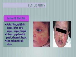 Dermatitis atopik