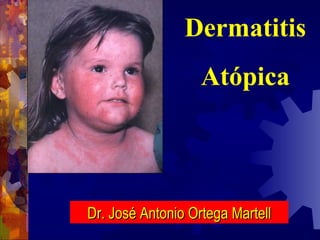 Dermatitis Atópica Dr. José Antonio Ortega Martell 