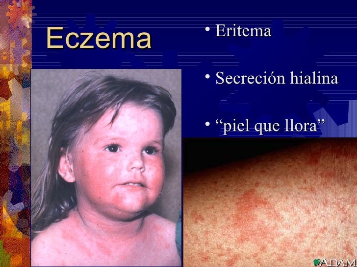 Nizoral la psoriasis el cuerpo