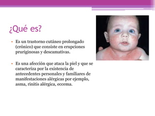 ¿Qué es?
• Es un trastorno cutáneo prolongado
  (crónico) que consiste en erupciones
  pruriginosas y descamativas.

• Es una afección que ataca la piel y que se
  caracteriza por la existencia de
  antecedentes personales y familiares de
  manifestaciones alérgicas por ejemplo,
  asma, rinitis alérgica, eccema.
 