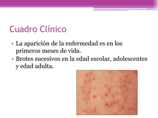 Cuadro Clínico
• La aparición de la enfermedad es en los
  primeros meses de vida.
• Brotes sucesivos en la edad escolar, adolescentes
  y edad adulta.
 