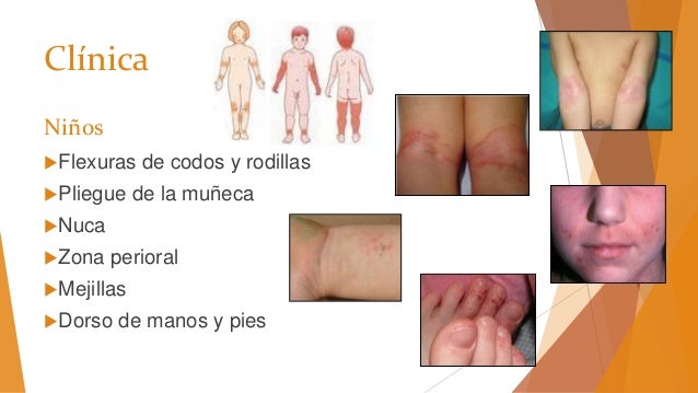 El régimen a atopicheskom la dermatitis