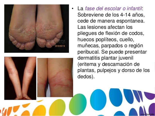 Que tal la psoriasis de la fotografía