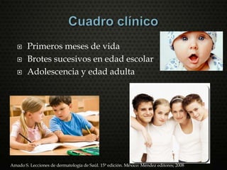  Primeros meses de vida
 Brotes sucesivos en edad escolar
 Adolescencia y edad adulta
Amado S. Lecciones de dermatología de Saúl. 15ª edición. México: Méndez editores; 2008
 