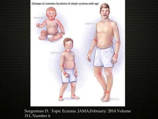 Sorgerman D. Topic Eczema. JAMA;February: 2014 Volume
311, Number 6
 