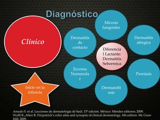 Clínico
Diferencia
l Lactante:
Dermatitis
Seborreica
Dermatitis
de
contacto
Dermatitis
alérgica
Micosis
fungoides
Psoriasis
Dermatofit
osis
Eccema
Nummula
r
Inicio en la
infancia
Amado S. et al. Lecciones de dermatología de Saúl. 15ª edición. México: Méndez editores; 2008.
Wolff K.,Allen R. Fitzpatrick’s color atlas and synopsis of clinical dermatology. 6th edition. Mc Graw
Hill; 2009.
 