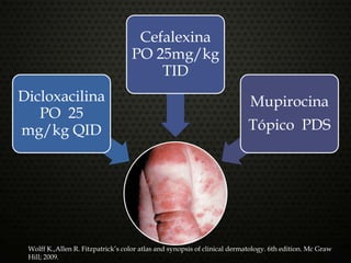 Dicloxacilina
PO 25
mg/kg QID
Cefalexina
PO 25mg/kg
TID
Mupirocina
Tópico PDS
Wolff K.,Allen R. Fitzpatrick’s color atlas and synopsis of clinical dermatology. 6th edition. Mc Graw
Hill; 2009.
 