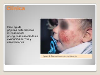 Clínica
Fase aguda:
pápulas eritematosas
intensamente
pruriginosas asociadas a
exudación serosa y
escoriaciones
 