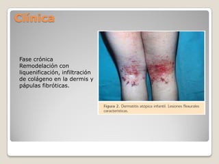 Clínica
Fase crónica
Remodelación con
liquenificación, infiltración
de colágeno en la dermis y
pápulas fibróticas.
 