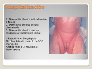 Hospitalización
1. Dermatitis atópica eritrodermica
o toxica
2. Dermatitis atópica severa
diseminada
3. Dermatitis atópica que no
responde a tratamiento inicial
Cilosporina A: 5mg/kg/dia
Micofenolato de mofetilo: 40-50
mg/kg/dia
Azatioprina: 1-3 mg/kg/dia
Metotrexate
 