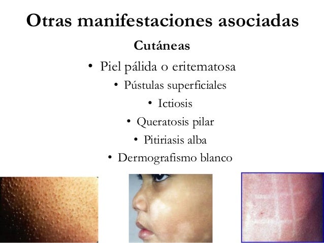 Que quitar la agudización de la psoriasis de la cabeza