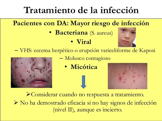 Los ungüentos de la psoriasis en la base vegetal
