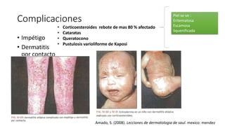 Complicaciones
• Impétigo
• Dermatitis
por contacto
• Corticoesteroides rebote de mas 80 % afectado
• Cataratas
• Queratocono
• Pustulosis varioliforme de Kaposi
Piel se ve :
Eritematosa
Escamosa
liquenificada
Amado, S. (2008). Lecciones de dermatologia de saul. mexico: mendez
 