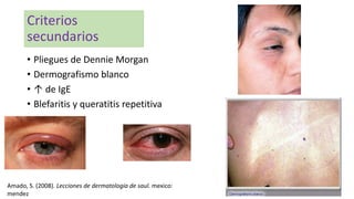 Criterios
secundarios
• Pliegues de Dennie Morgan
• Dermografismo blanco
• ↑ de IgE
• Blefaritis y queratitis repetitiva
Amado, S. (2008). Lecciones de dermatologia de saul. mexico:
mendez
 