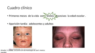 Cuadro clínico
• Primeros meses de la vida con brotes sucesivos la edad escolar .
• Aparición tardía: adolecentes y adultos
Amado, S. (2008). Lecciones de dermatologia de saul. mexico:
mendez
 
