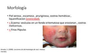 Morfología
• Piel xerosa , escamosa , pruriginosa, costras hemáticas ,
liquenificacion (cronicidad).
• + Eczema: vesículas en un fondo eritematoso que erosionan , costras
melicericas.
• + Finas Pápulas
Amado, S. (2008). Lecciones de dermatologia de saul. mexico:
mendez
 
