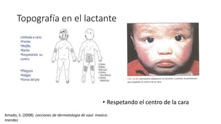 Topografía en el lactante
• Respetando el centro de la cara
Amado, S. (2008). Lecciones de dermatologia de saul. mexico:
mendez
 